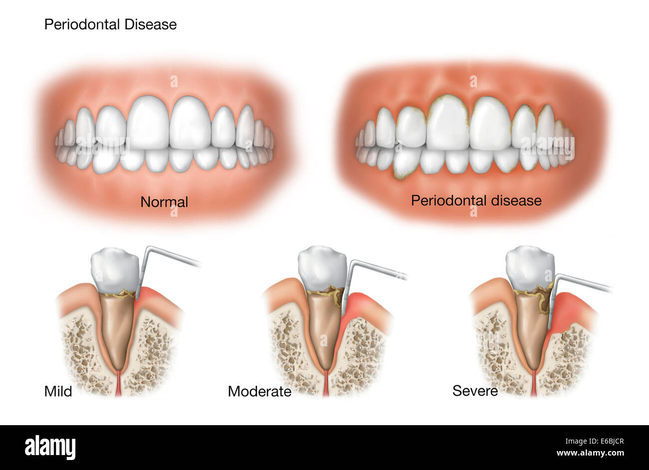 Three stages of periodontal disease. Stock Photo