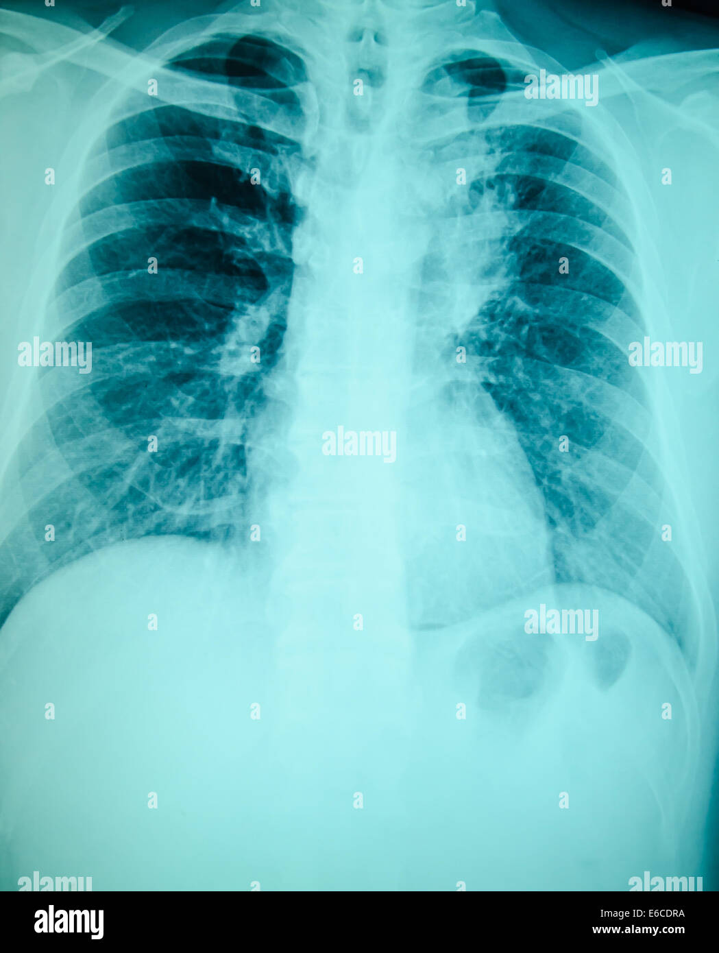 chest xray examination for diagnosis Stock Photo Alamy