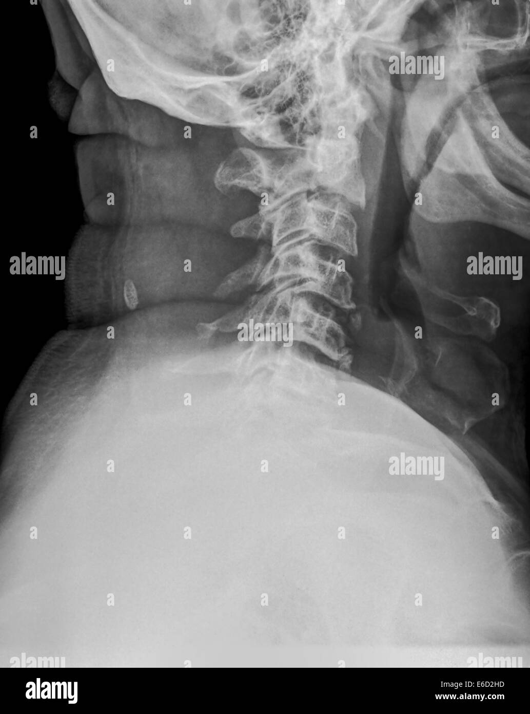 Normal Cervical spine x-ray of a 63 year old male patient side view Stock Photo