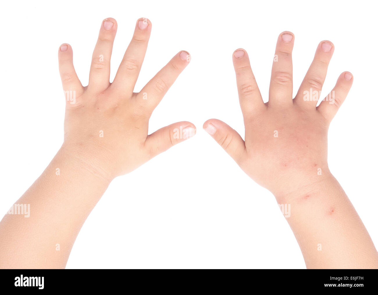 swollen and healthy baby hands isolated on white background Stock Photo