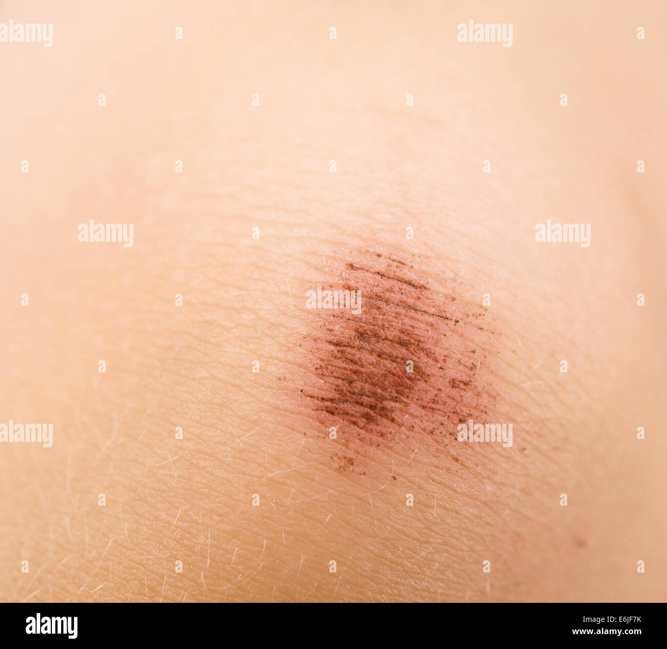 Swollen knee hires stock photography and images Alamy