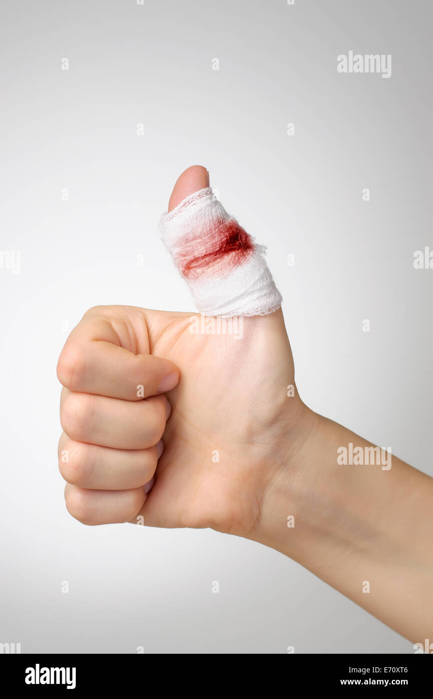 Injured finger with bloody gauze bandage Stock Photo Alamy