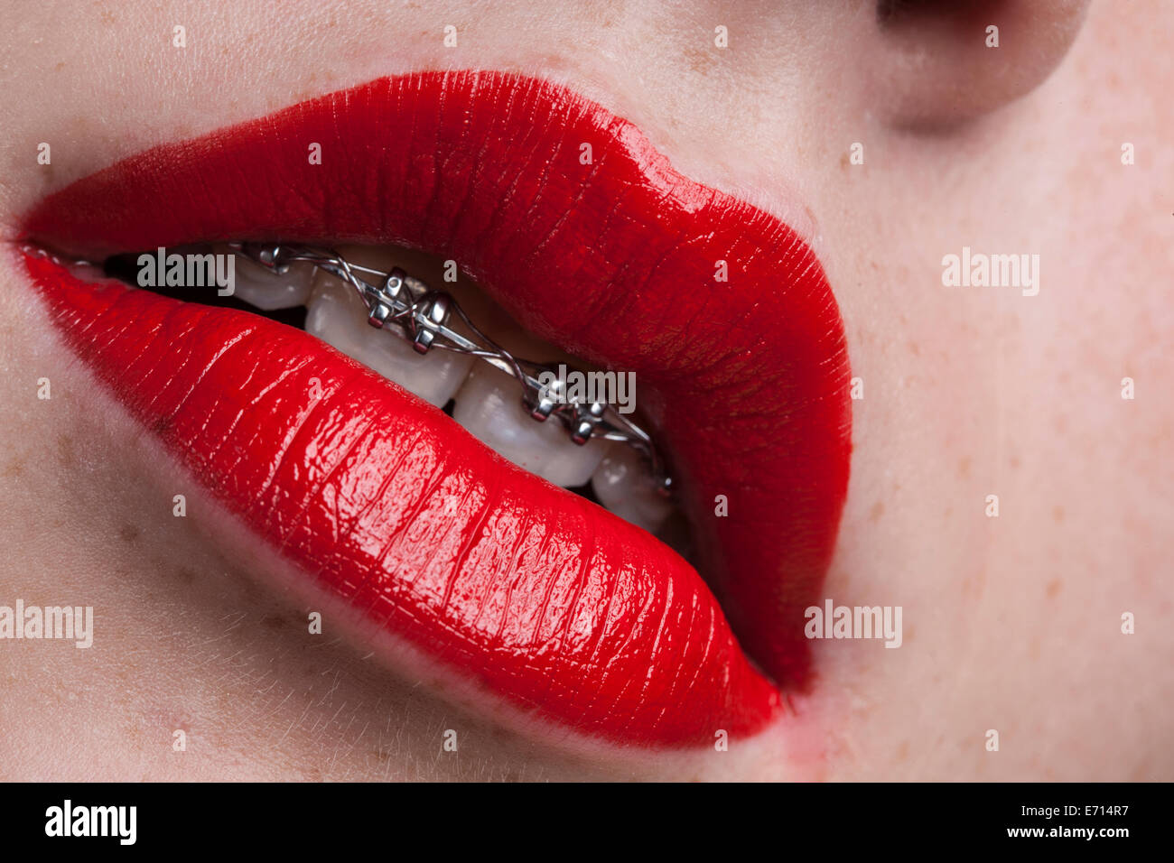 Woman's lips with red lipstick and braces Stock Photo Alamy