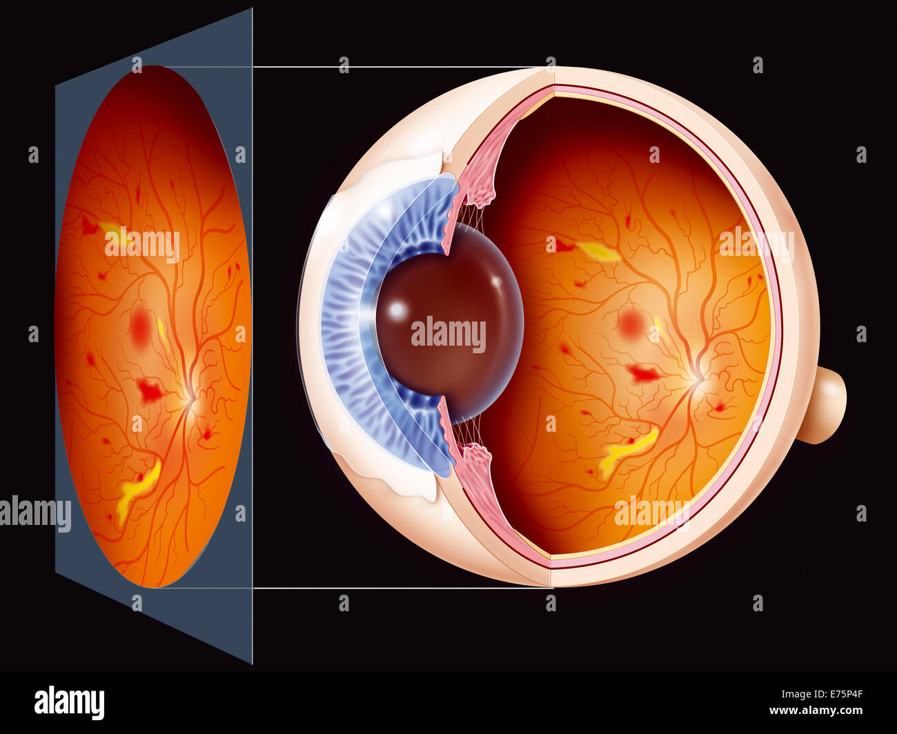 Diabetic retinopathy, drawing Stock Photo