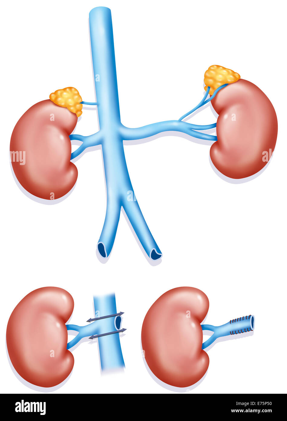 Transplant kidney, illustration Stock Photo