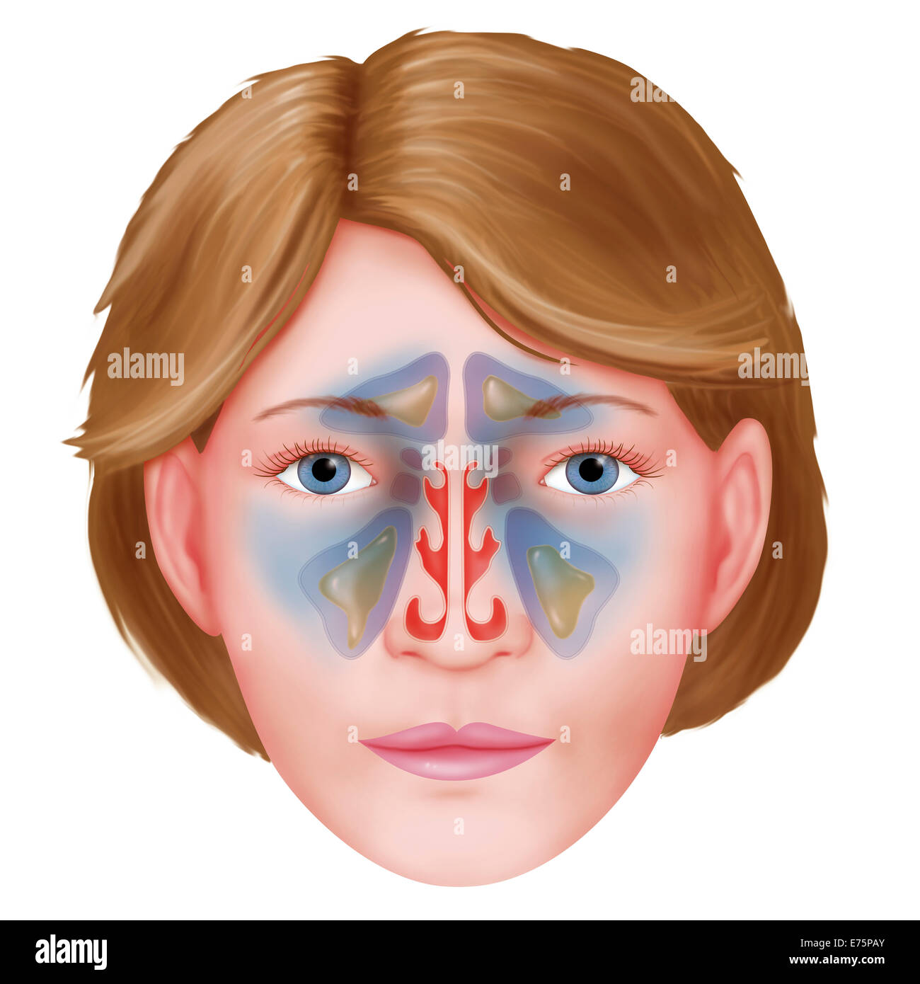 Sinusitis, drawing Stock Photo