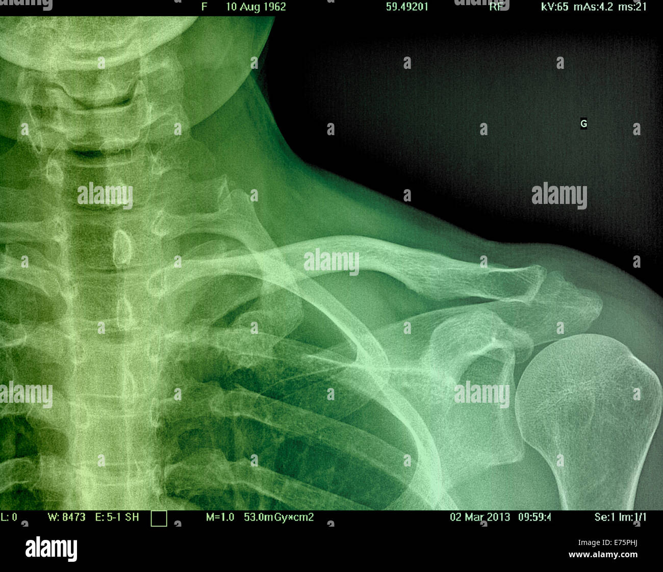 Collarbone X Ray Stock Photo Alamy