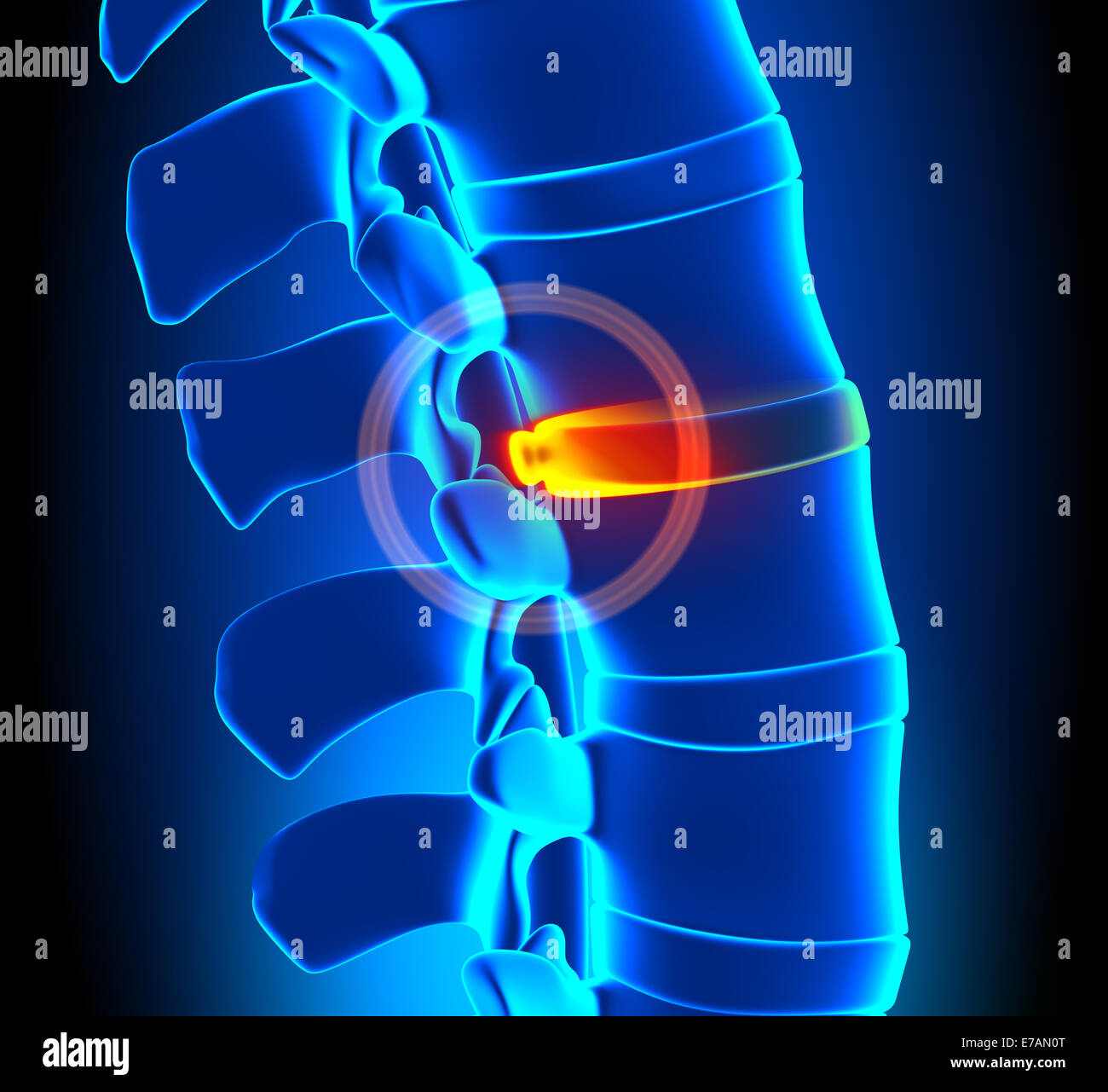 Bulging Disc Degeneration - Spine problem Stock Photo