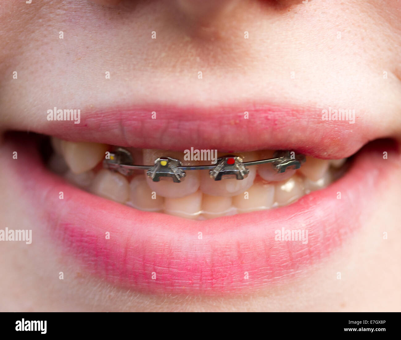 girls wearing orthodontic braces on teeth Stock Photo Alamy