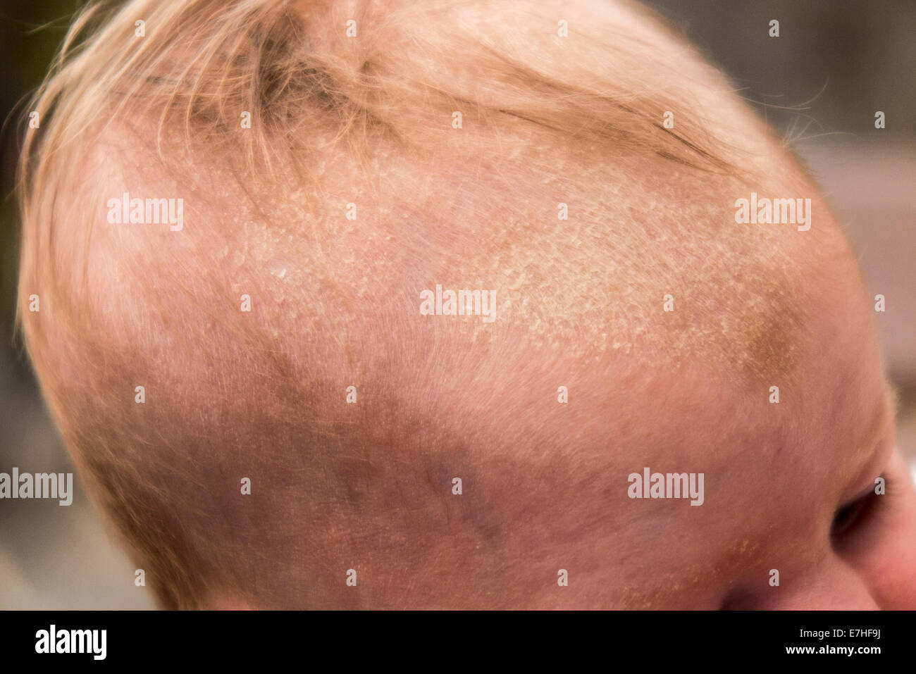 Cradle cap sales 7 month old