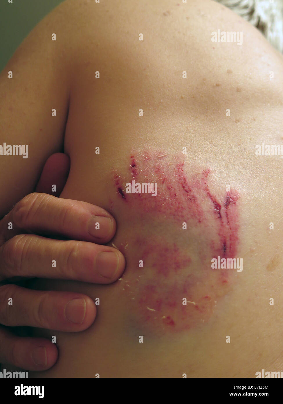 Older Caucasian woman with a dog bite on her back. Stock Photo
