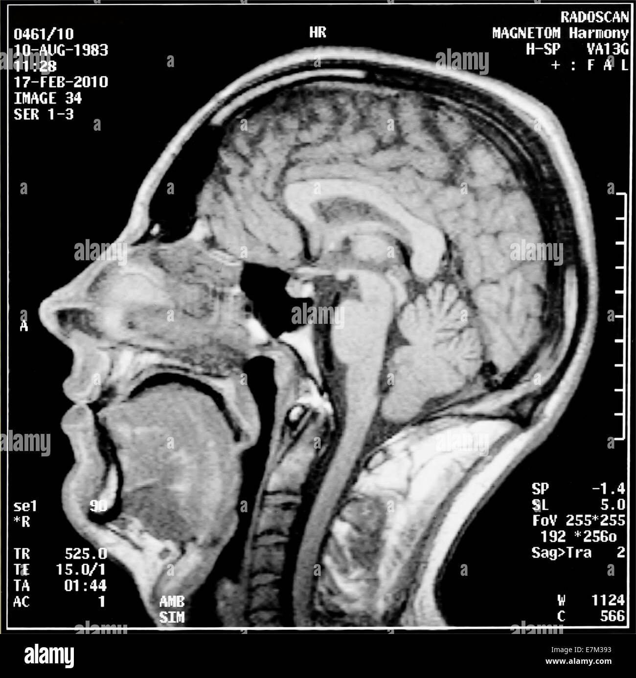 Magnetic resonance imaging, the image of the head in different planes Stock Photo