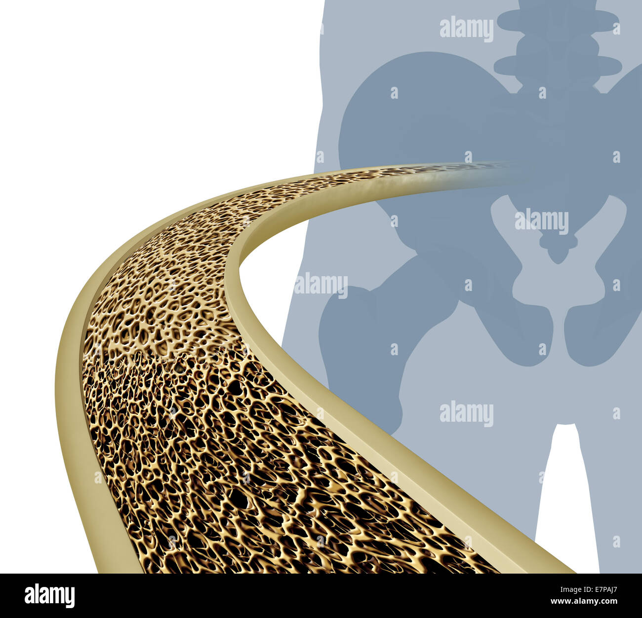 Osteoporosis medical illustration concept as a close up diagram of the inside of a human bone from a skeletal hip joint as a normal healthy condition gradually degrades to abnormal unhealthy bone mass on a white background. Stock Photo