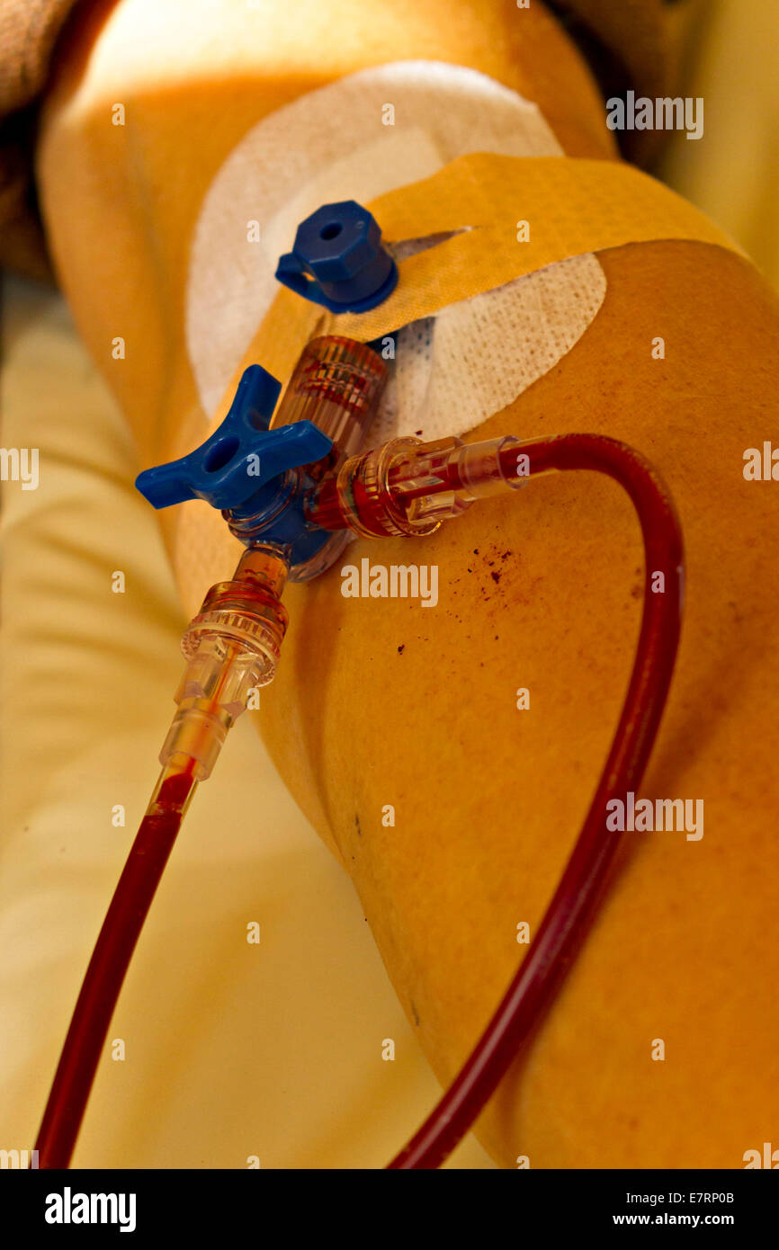 Patient receiving a blood transfusion. - 30 August 2014 Stock Photo