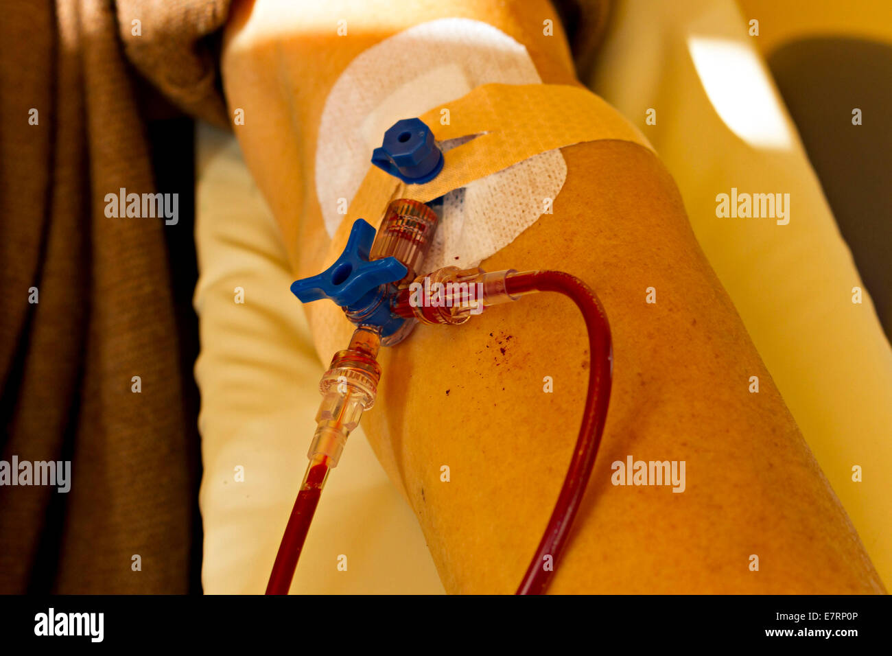 Patient receiving a blood transfusion. - 28 August 2014 Stock Photo