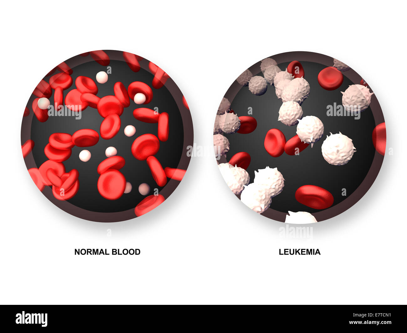 Leukemia vs Normal Blood Stock Photo
