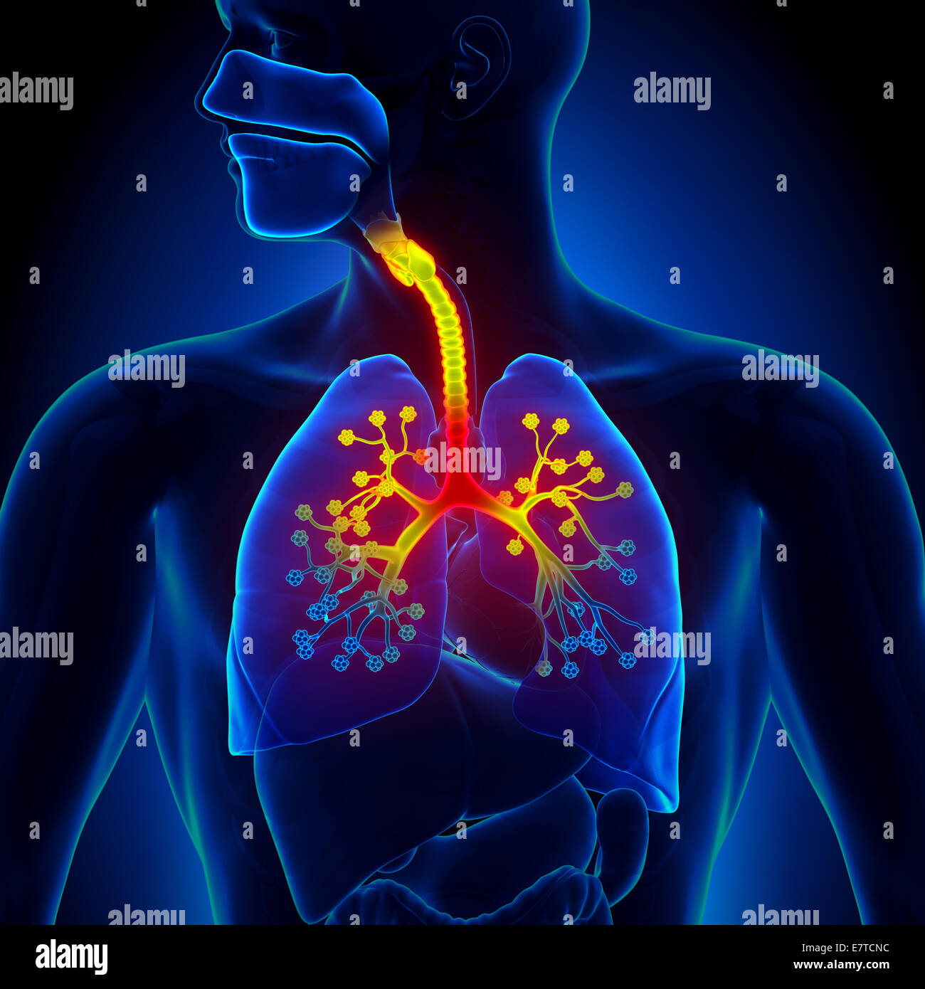 Bronchiolitis - Inflammation of the bronchioles Stock Photo