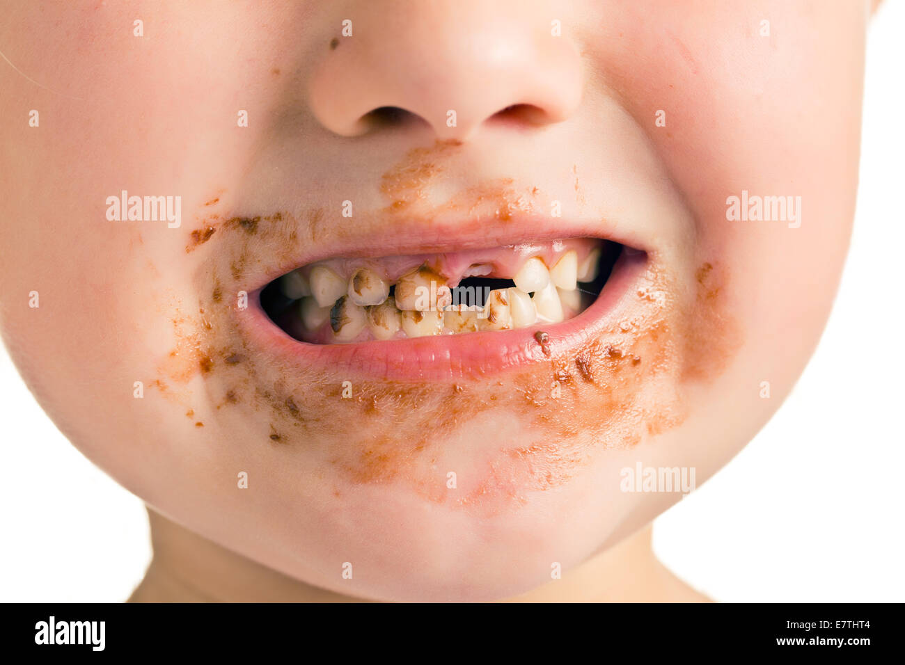 the child with a dirty mouth and missing tooth Stock Photo