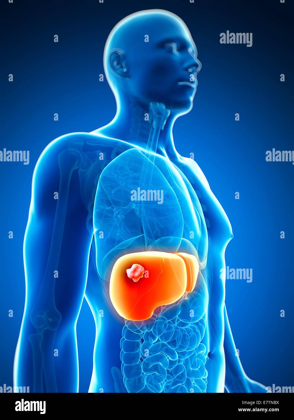 Human liver cancer, computer artwork Stock Photo - Alamy