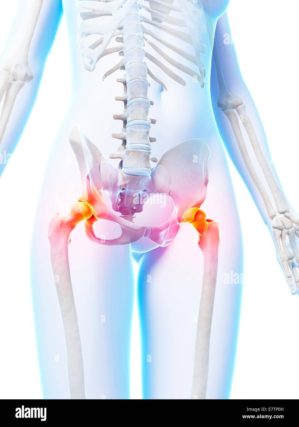 Painful human hip joints, computer artwork. Stock Photo