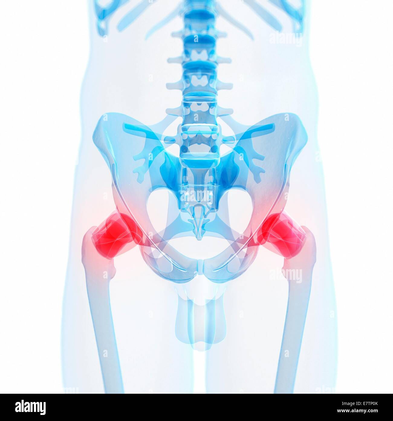 Painful human hip joints, computer artwork. Stock Photo