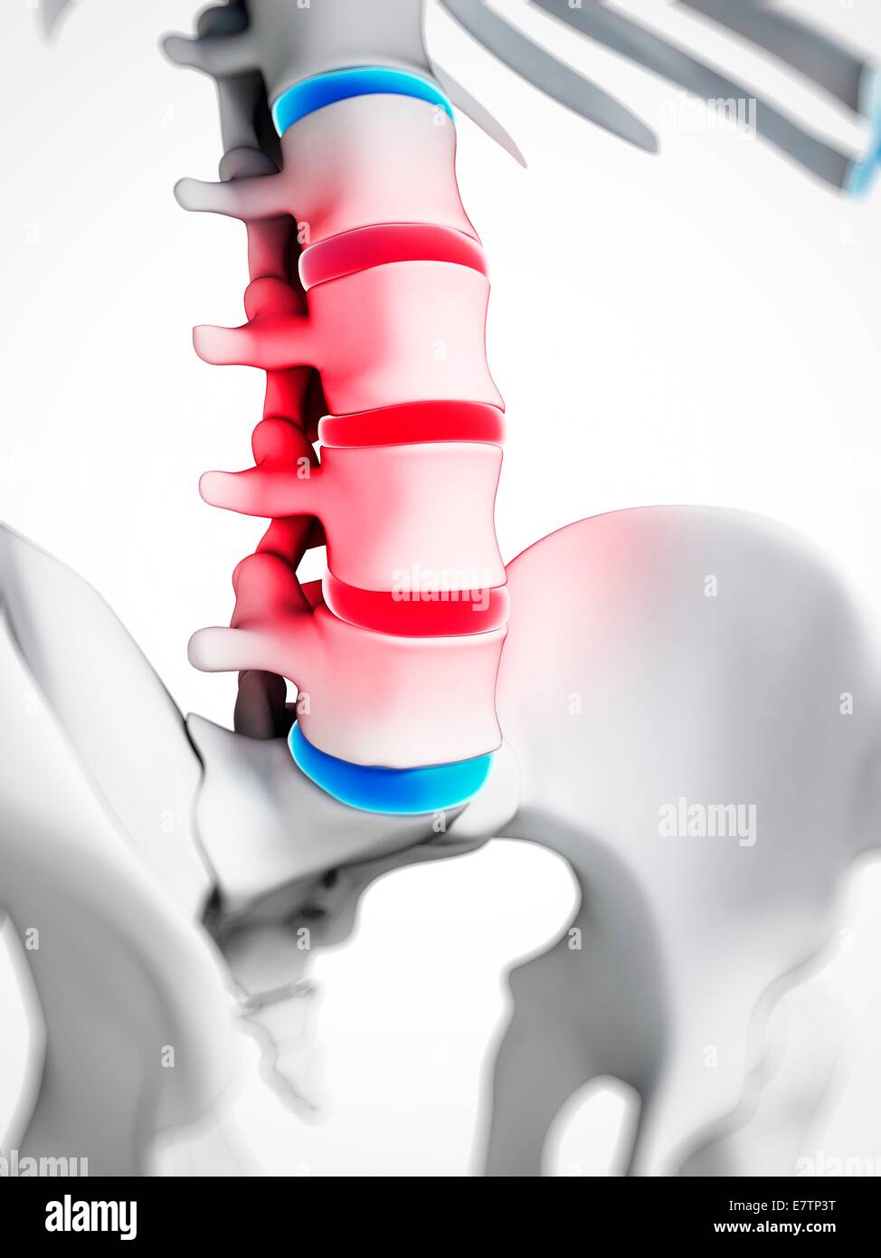 Human spinal disc herniation (slipped disc), computer artwork. Stock Photo