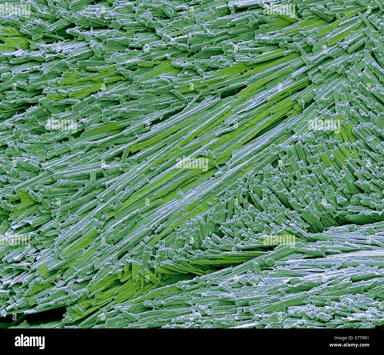 Coloured scanning electron micrograph (SEM) of uric acid crystals from the toe of a patient with gout. Magnified X 2000 at 10cm wide. Stock Photo