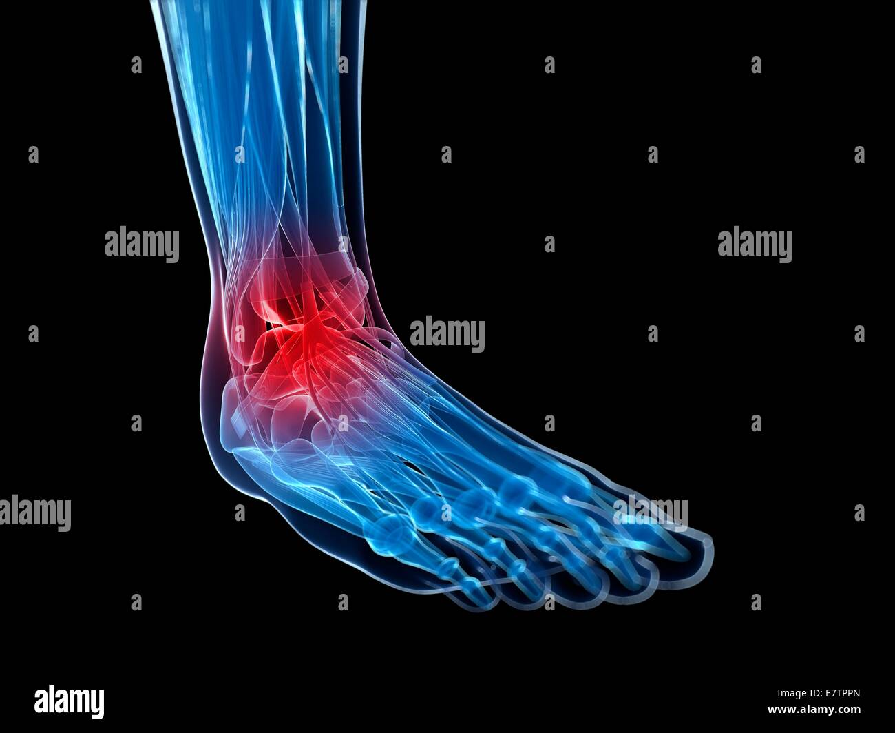 Human ankle pain, computer artwork Stock Photo - Alamy