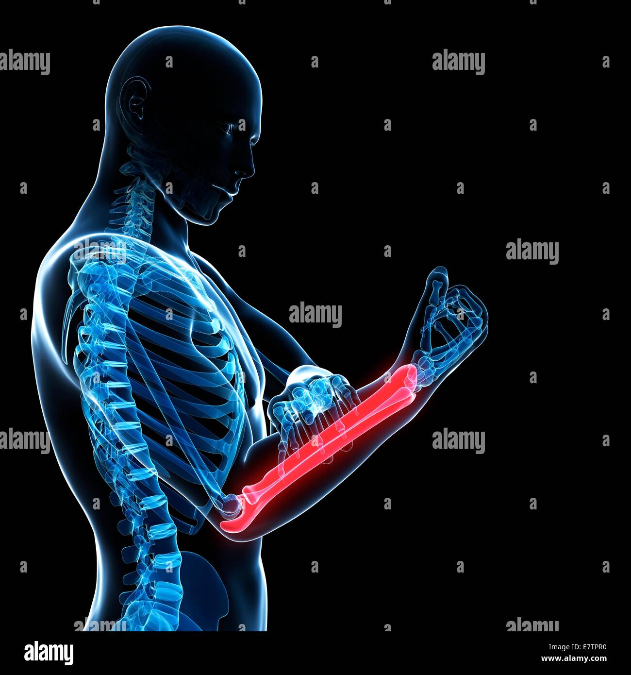 Human arm pain, computer artwork Stock Photo Alamy