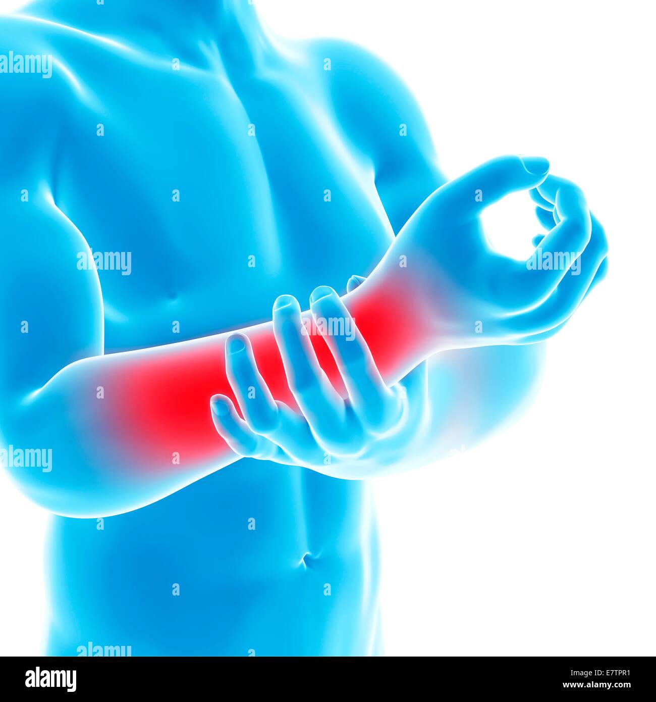 Human arm pain, computer artwork Stock Photo Alamy