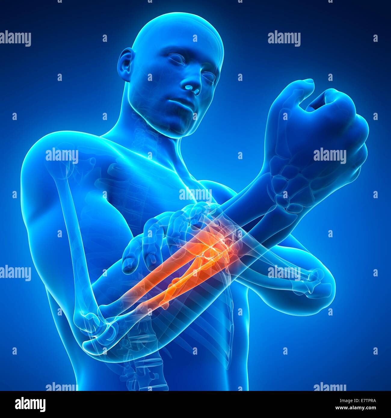 Human arm pain, computer artwork Stock Photo Alamy