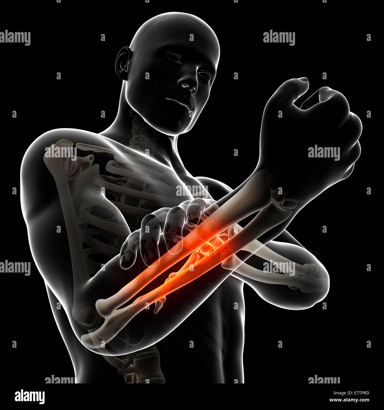 Human arm pain, computer artwork Stock Photo Alamy