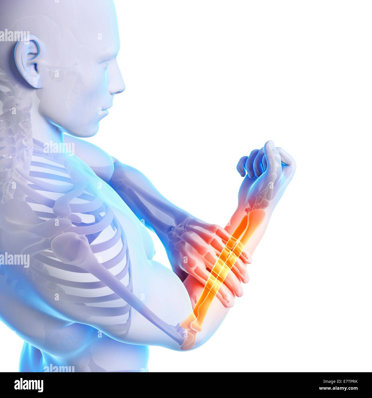 Human arm pain, computer artwork Stock Photo Alamy