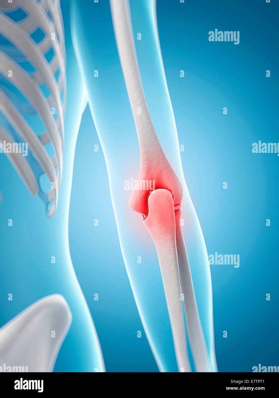 Human elbow pain, computer artwork Stock Photo - Alamy