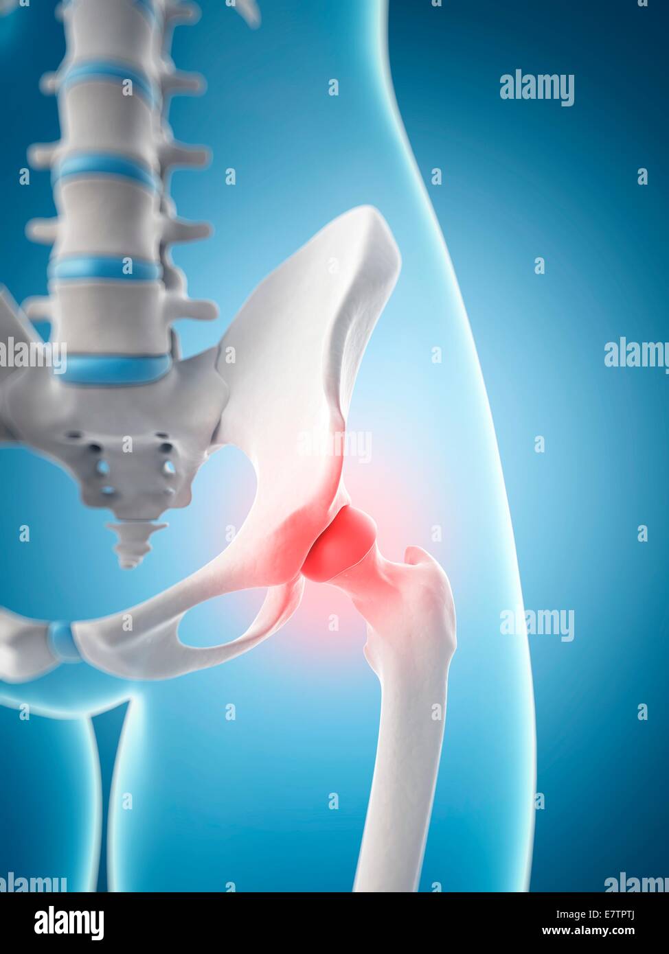 Human hip pain, computer artwork Stock Photo - Alamy
