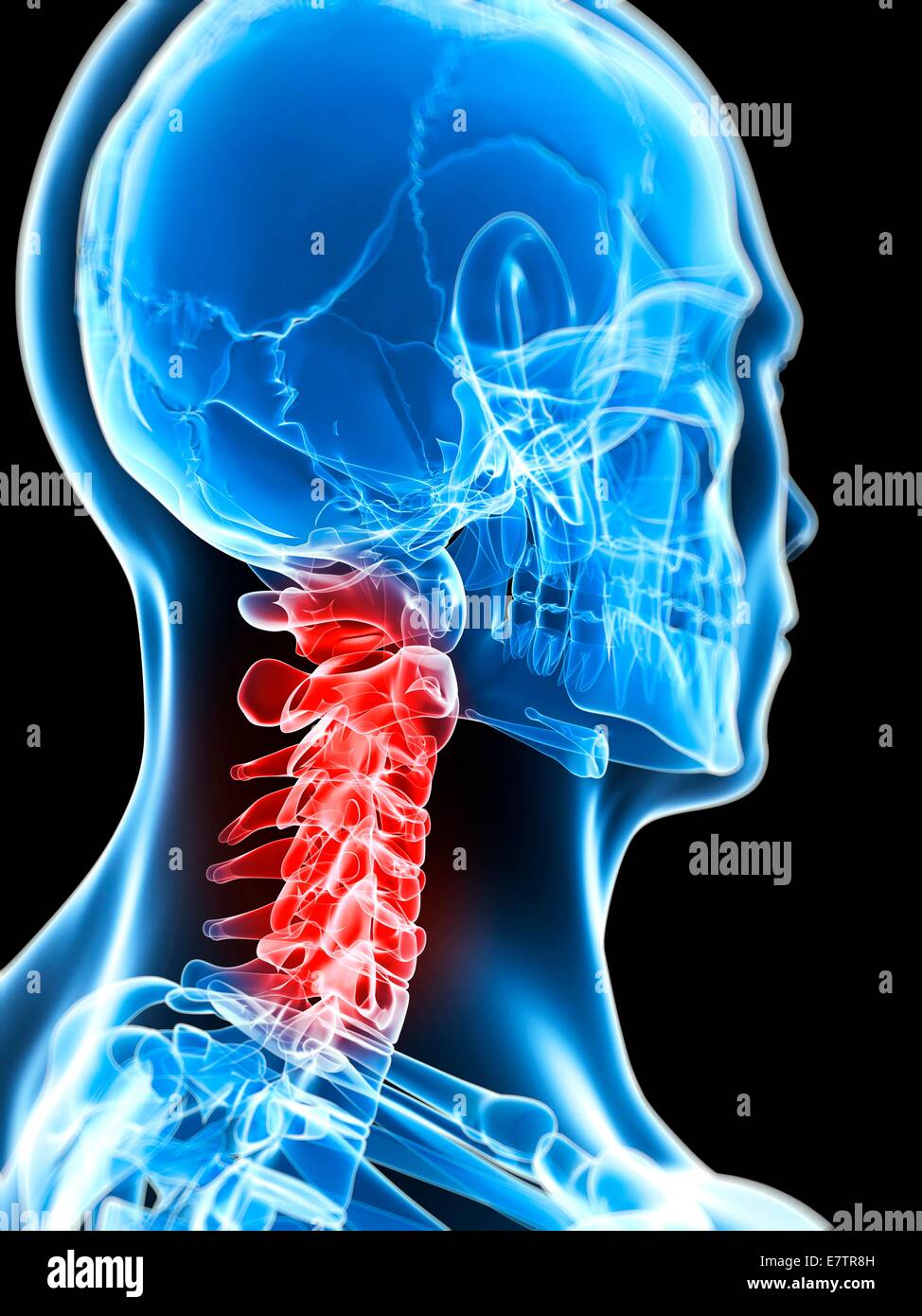 Human neck pain, computer artwork Stock Photo Alamy