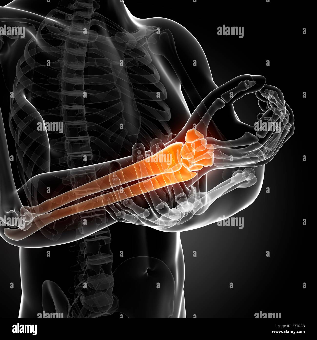 Human arm pain, computer artwork Stock Photo Alamy