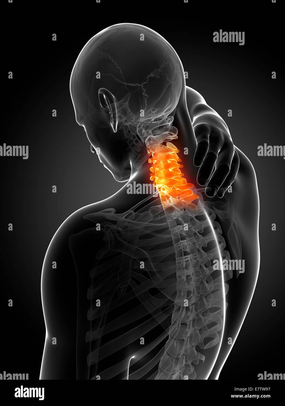 Human neck pain, computer artwork Stock Photo Alamy