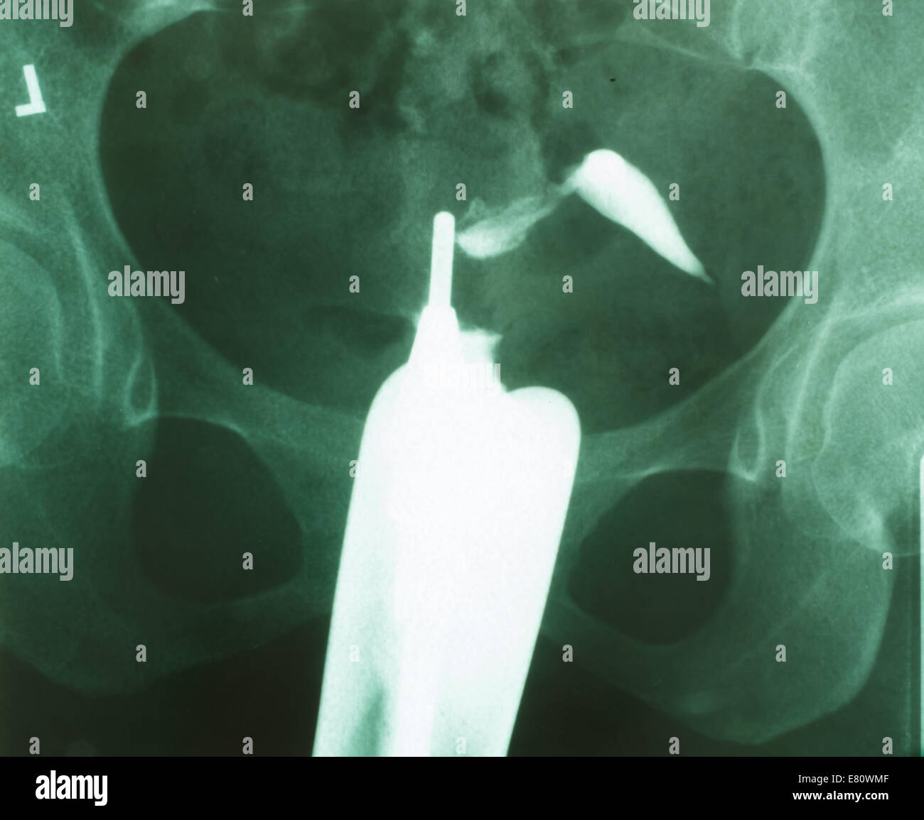 Female Chest X Ray High Resolution Stock Photography and Images - Alamy