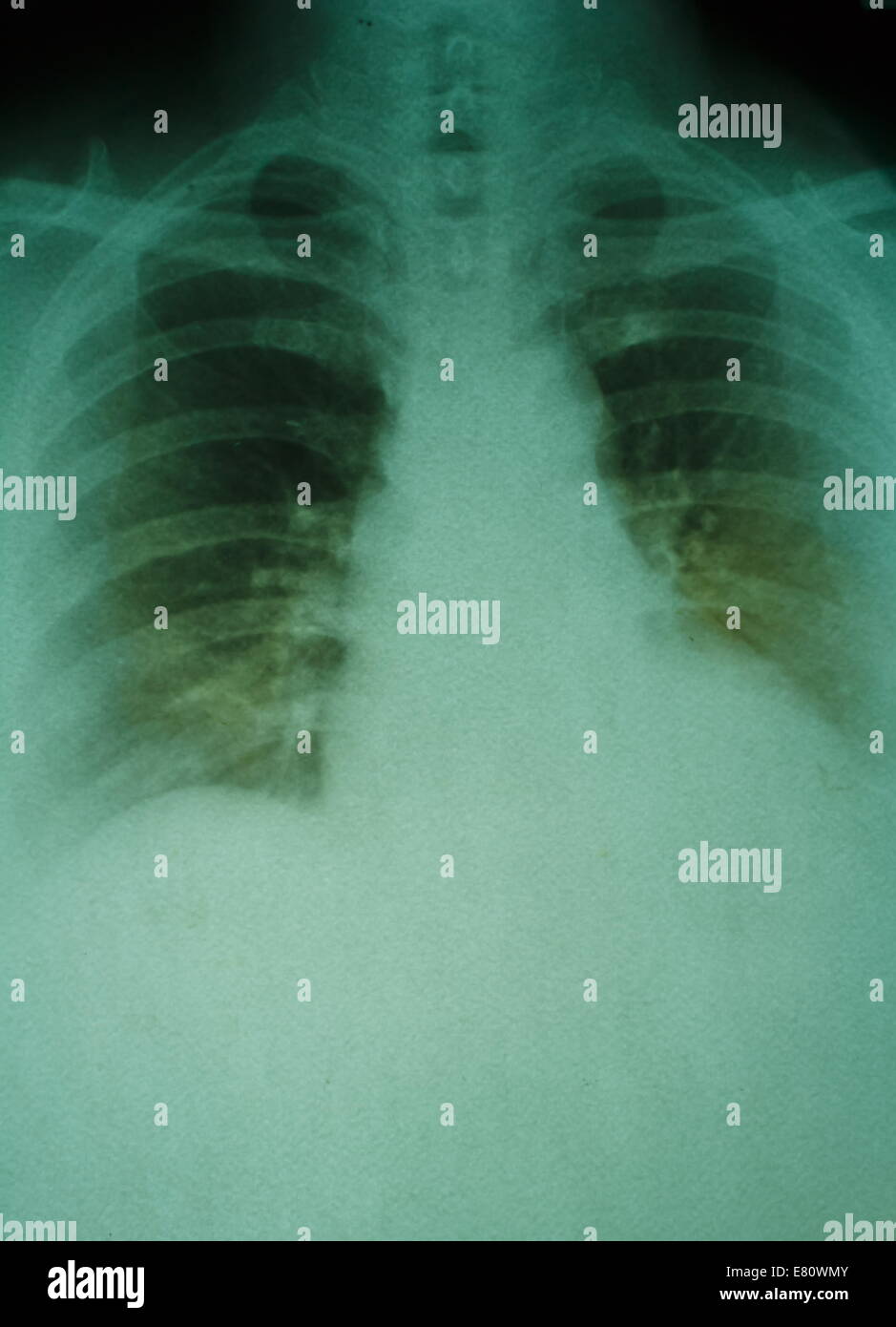 X ray of female pelvis hi-res stock photography and images - Alamy