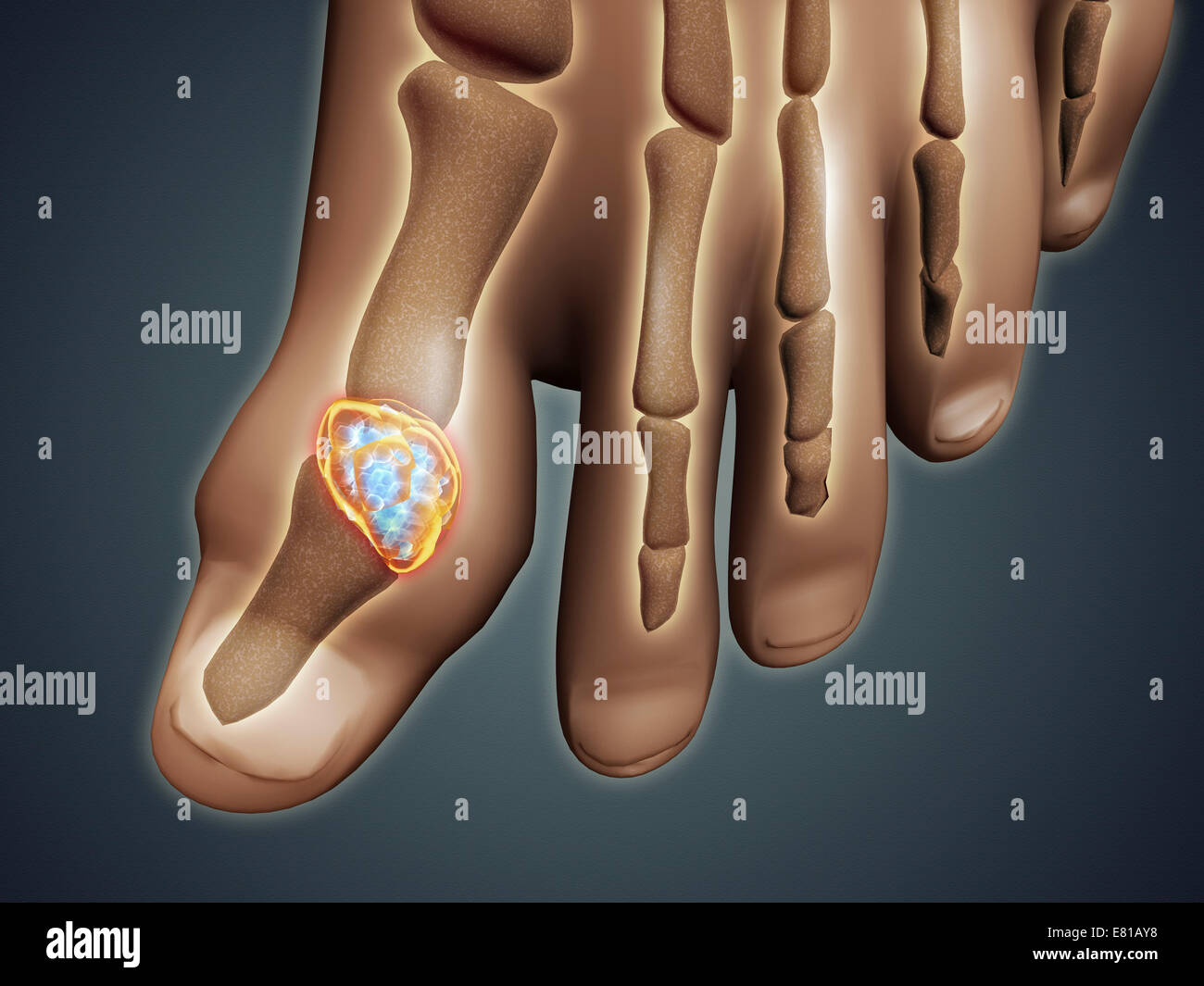 Conceptual image of gout in the big toe. Gout is a form of inflammatory arthritis that causes sudden, severe pain, swelling and Stock Photo