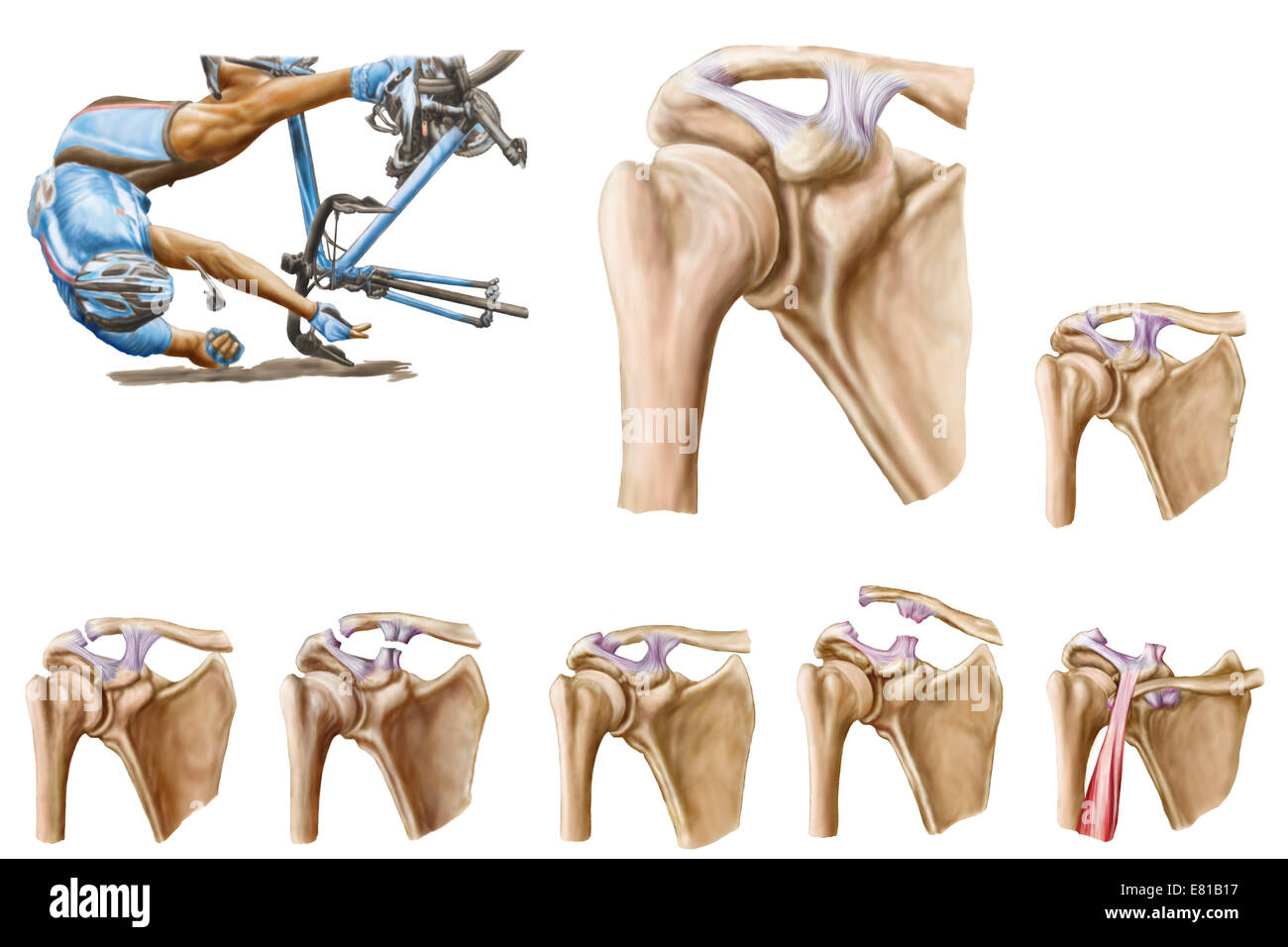 Anatomy of acromioclavicular joint rupture and displacement. Stock Photo