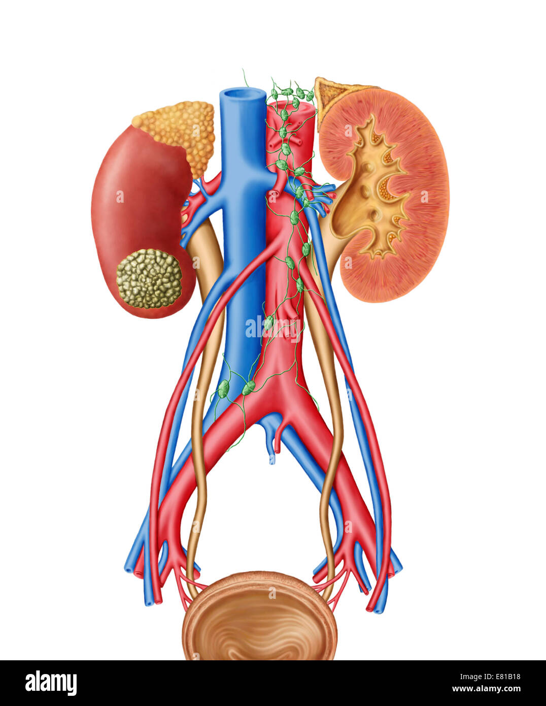 Early stage of kidney cancer with a tumor visible on the kidney. Stock Photo