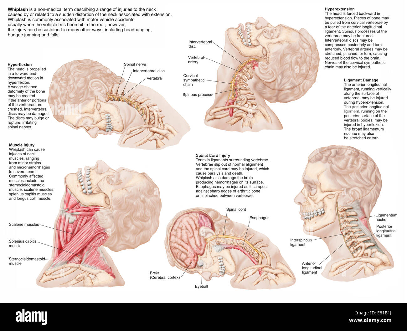 Medical chart showing the range of injuries to the human neck caused by whiplash. Stock Photo