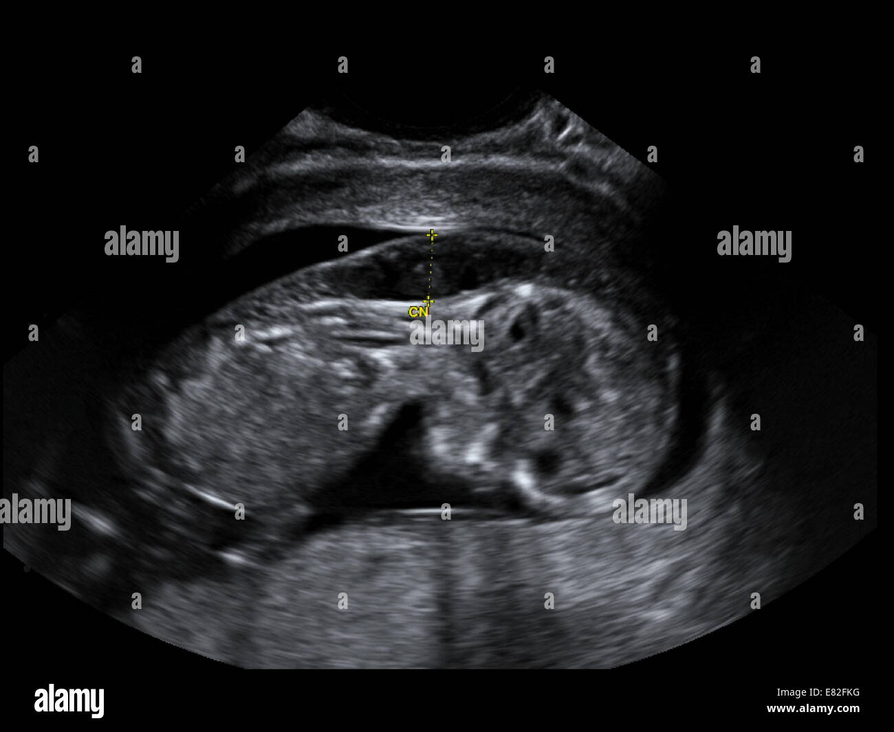 Ultrasound scan of a foetus showing nuchal scan for Down's Syndrome, Gestational age : 12 weeks. Stock Photo
