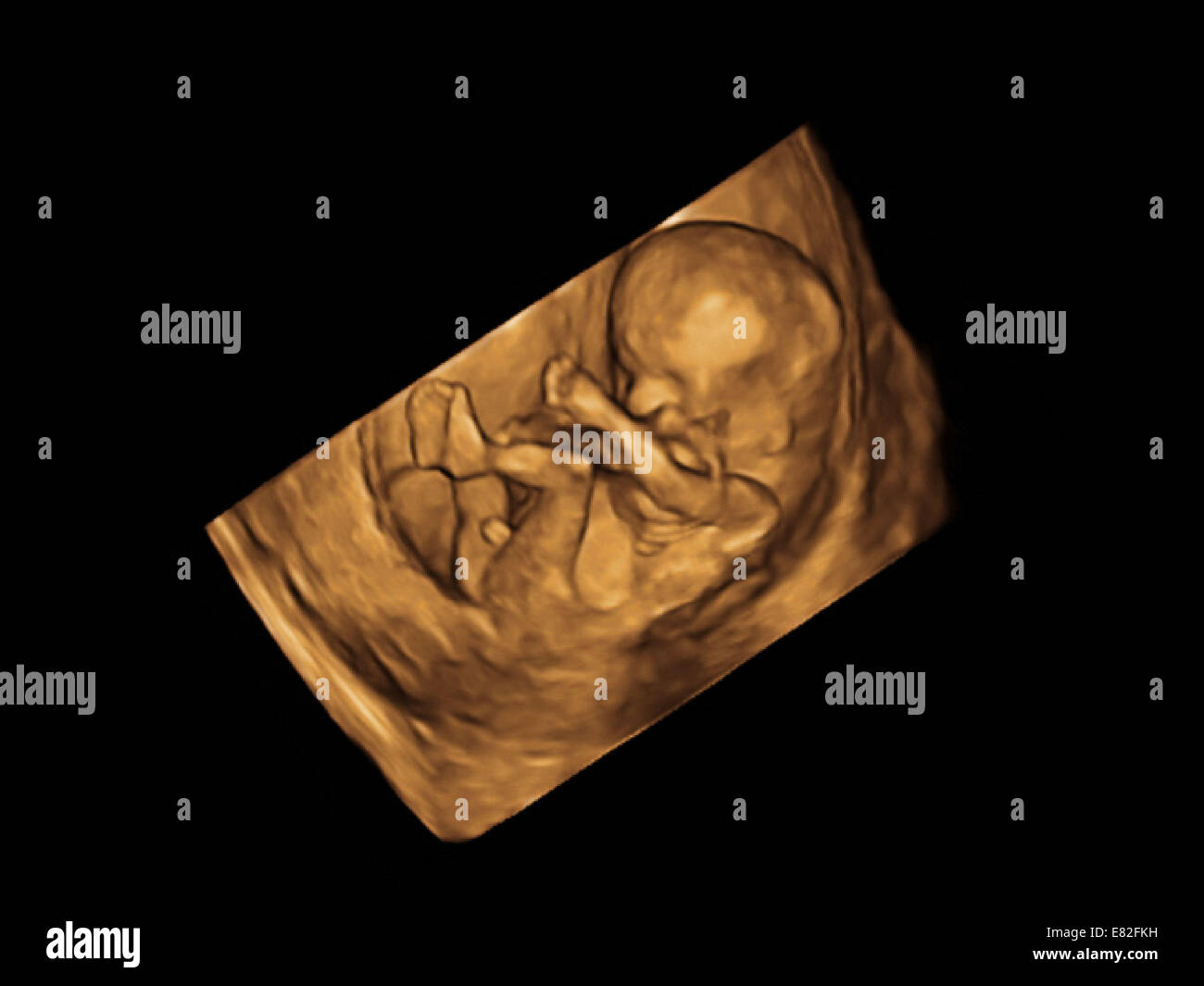 Coloured 3-D ultrasound scan of a foetus, Gestational age : 11 weeks and 5 days. Stock Photo