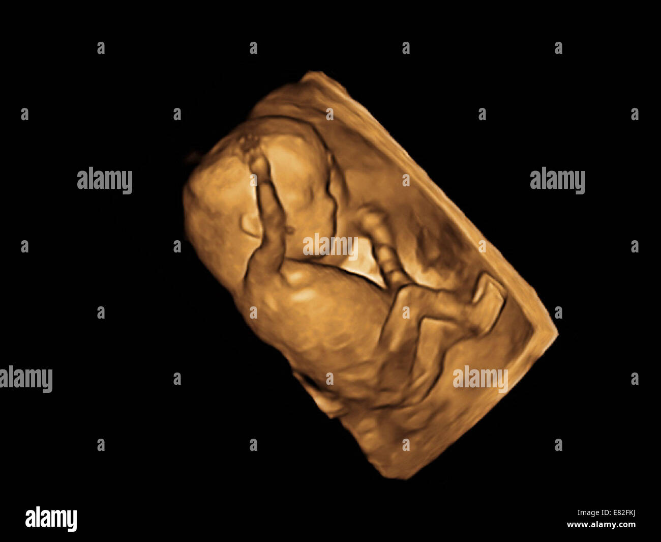 Coloured 3-D ultrasound scan of a foetus, Gestational age : 12 weeks and 3 days. Stock Photo