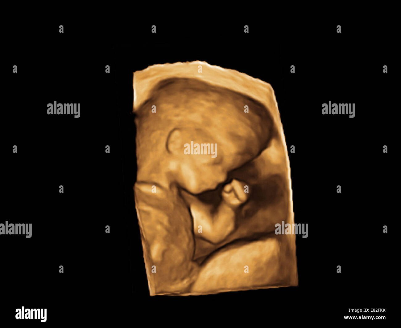 Coloured 3-D ultrasound scan of a foetus, Gestational age : 12 weeks and 2 days. Stock Photo
