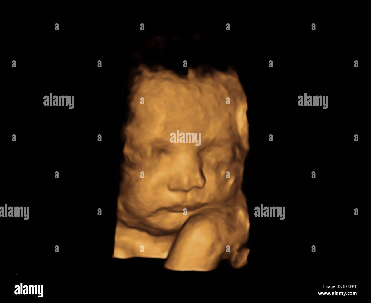 Foetus' face, Coloured 3-D ultrasound scan of a foetus, Gestational age : 32 weeks and 4 days. Stock Photo