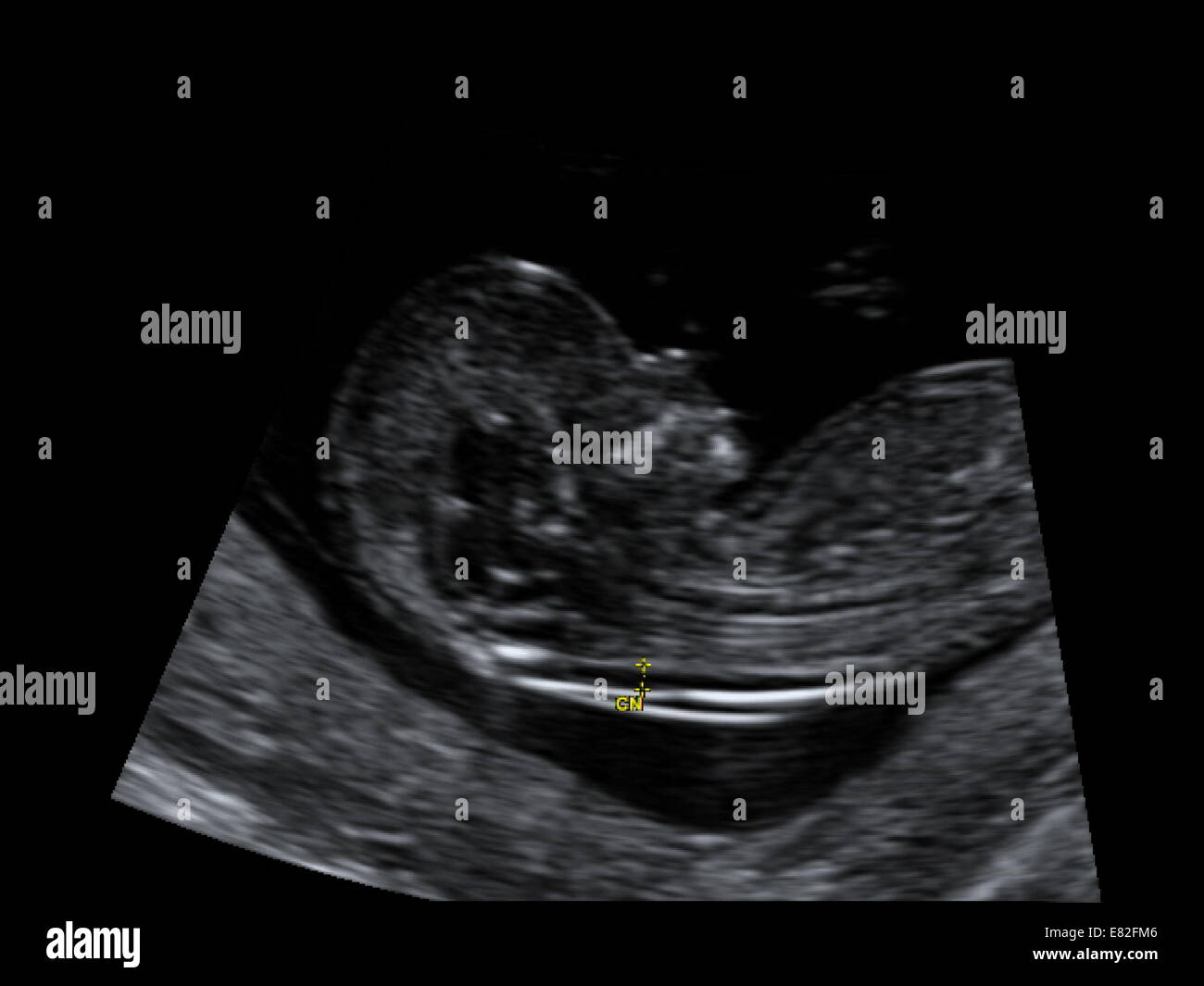 Ultrasound scan of a foetus showing nuchal scan for Down's Syndrome, Gestational age : 12 weeks and 3 days. Stock Photo